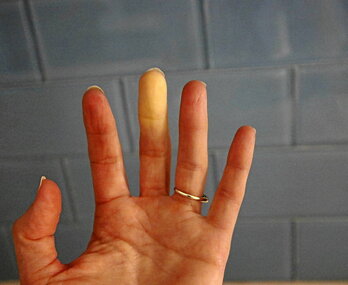 Raynauden sindromea dutenei, hotzarekin erasandako gunea zuritu eta mindu egiten zaie.